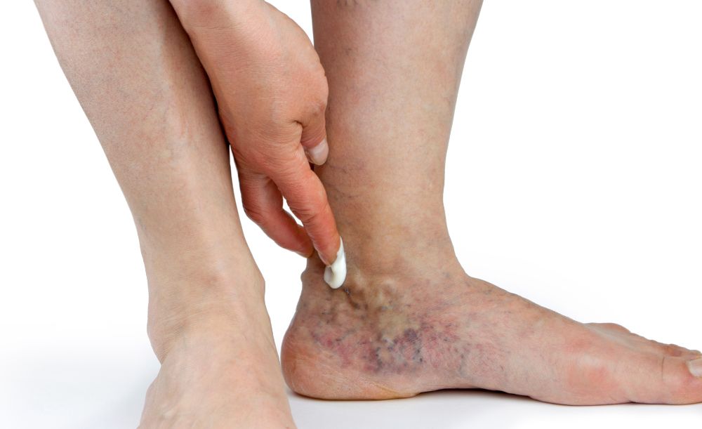 Varicose veins in legs showing swollen and distorted blood vessels related to varco veins.