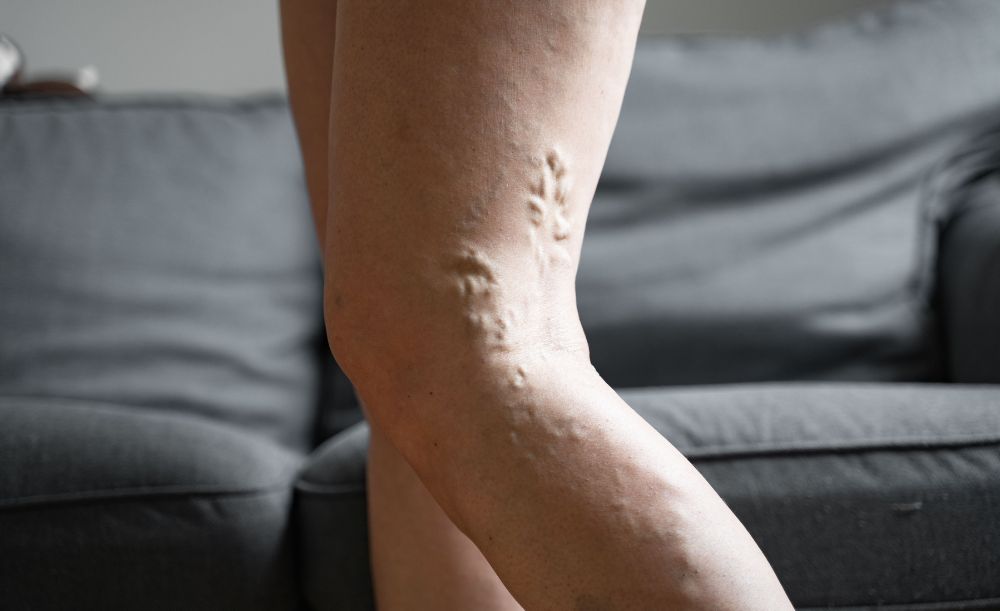 Varicose veins in legs showing swollen and distorted blood vessels related to varco veins.