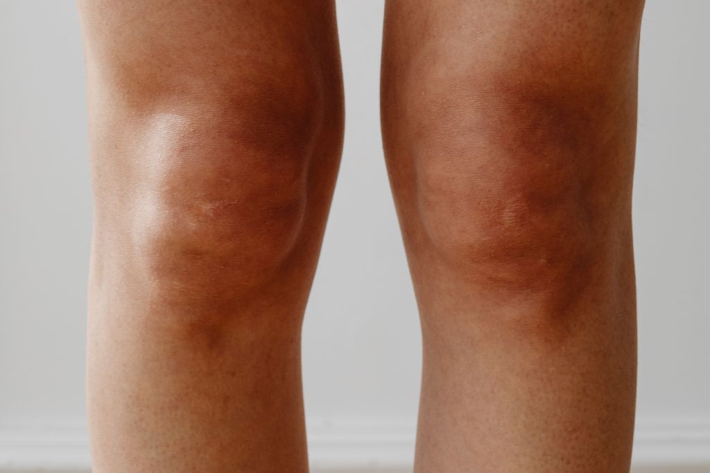 knock knees treatment in dubai