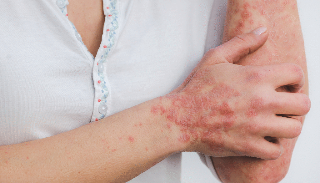 Psoriasis treatment near me