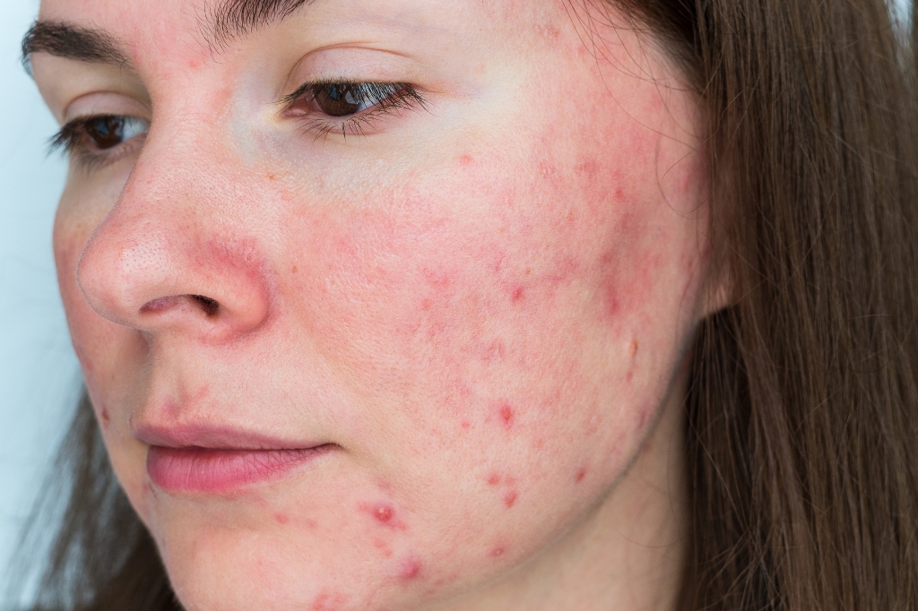 pistorius rosacea
