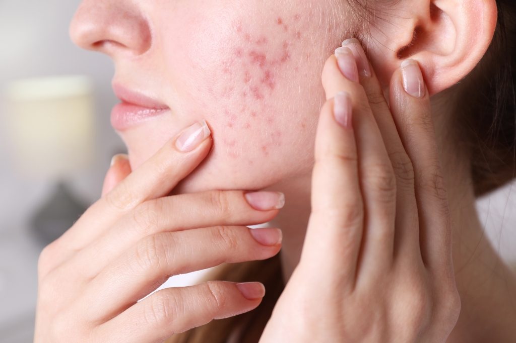 rosacea skin