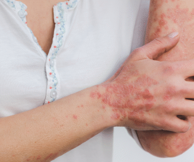 Psoriasis treatment near me