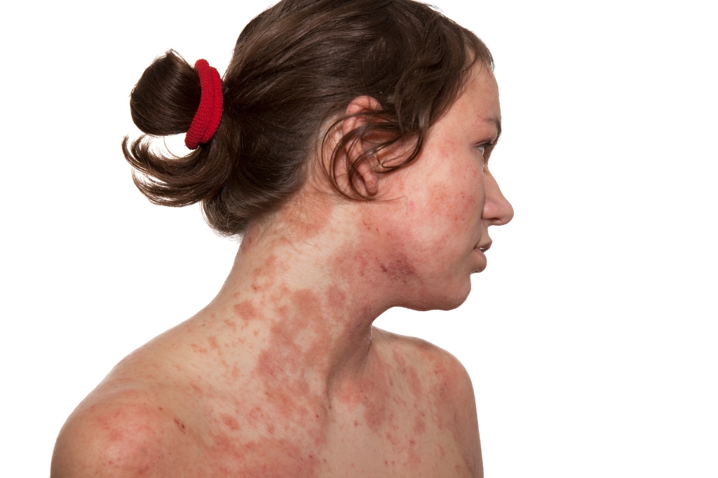 dermatitis rash