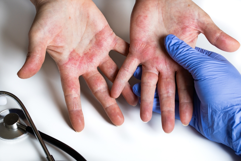 dermatitis treatment in dubai