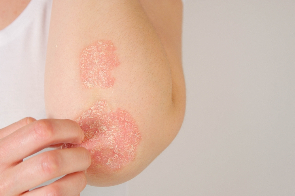 Psoriasis treatment in uae