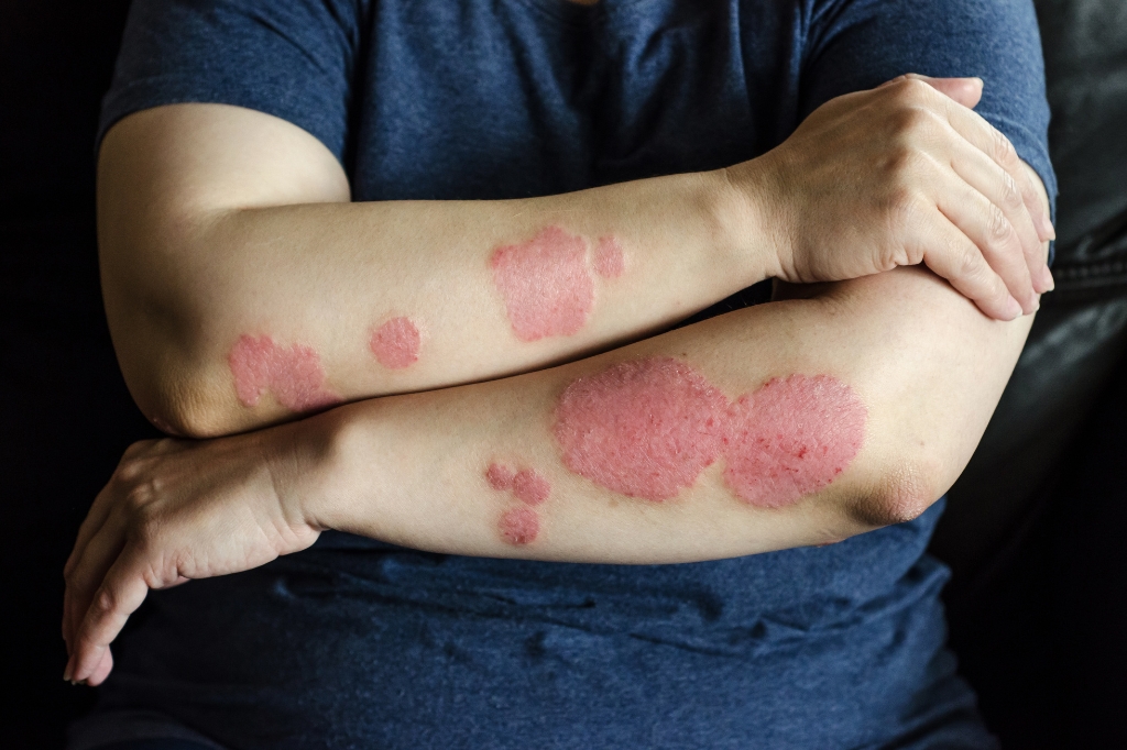 psoriasis treatment in dubai