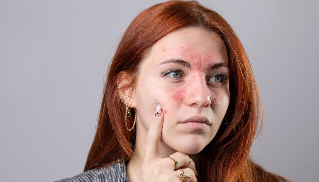 rosacea treatment in dubai