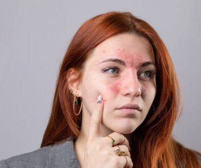 rosacea treatment in dubai