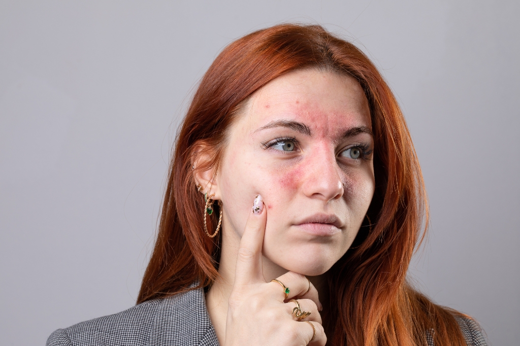 rosacea treatment in dubai