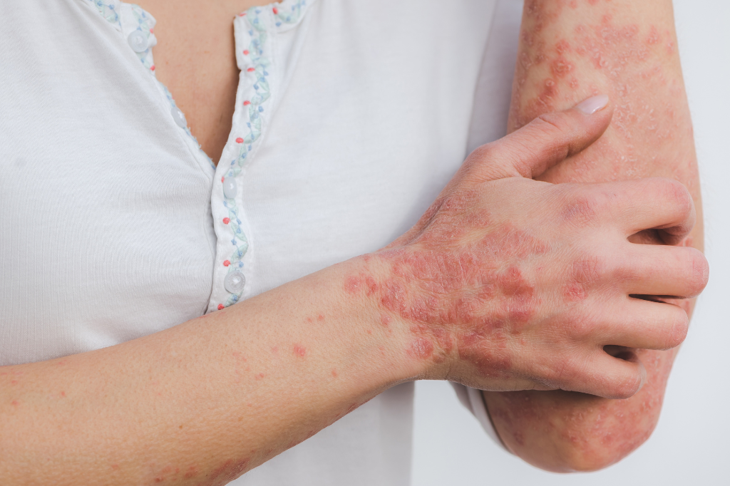 Psoriasis treatment near me