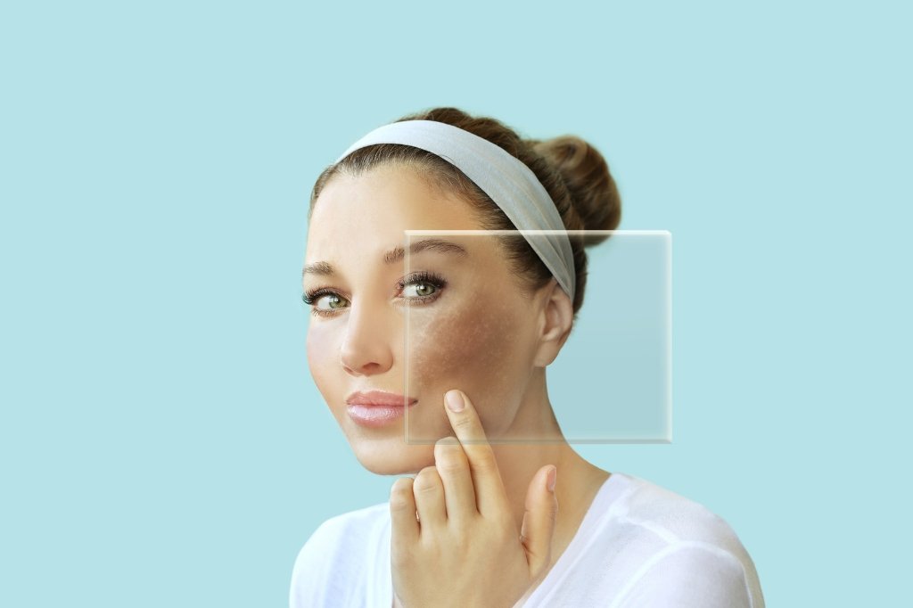 melasma treatment in dubai