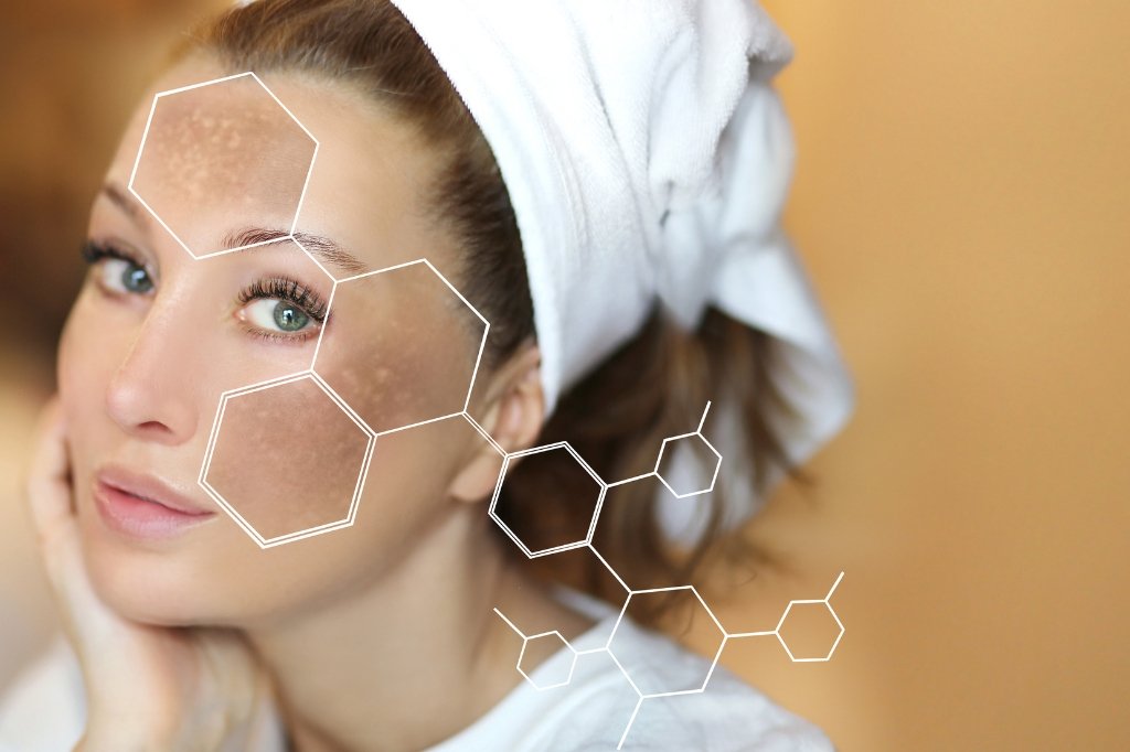 best melasma treatment
