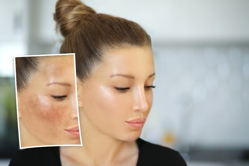 melasma treatment
