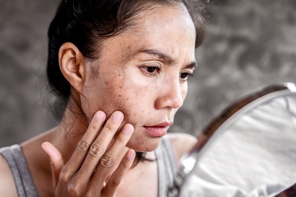 melasma treatment near me
