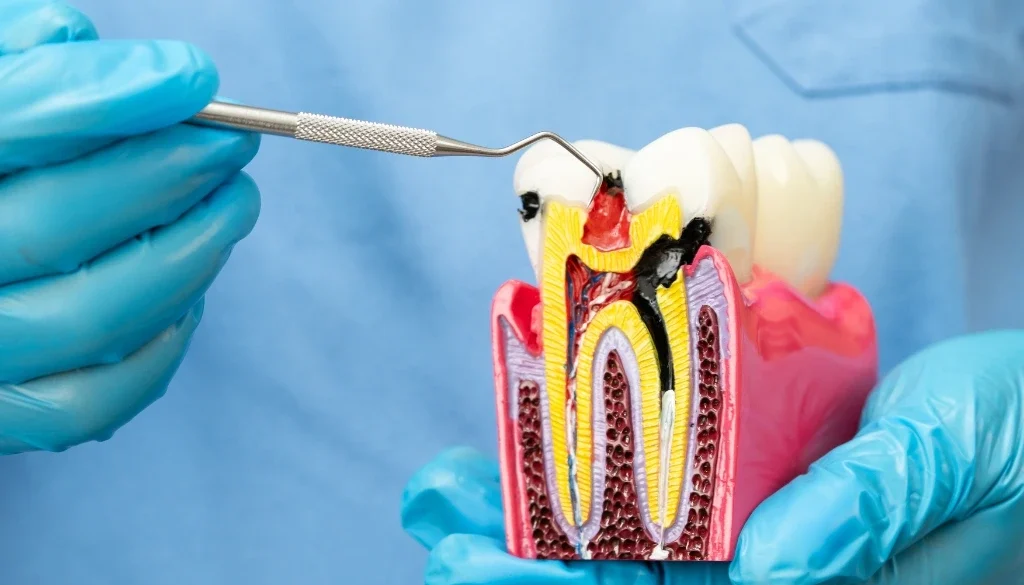 root canal specialist Dubai