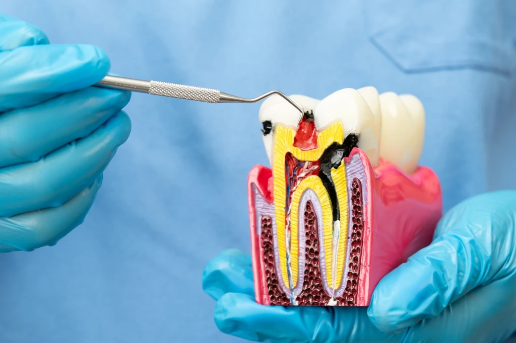 root canal specialist Dubai