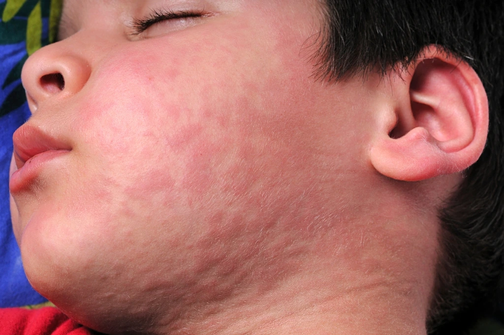 allergic skin reaction