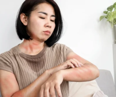 urticaria treatment urticaria treatment