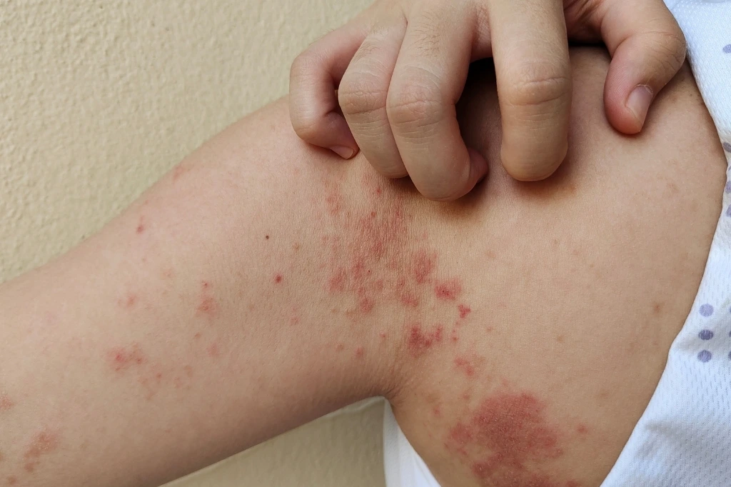 skin allergy treatment in dubai