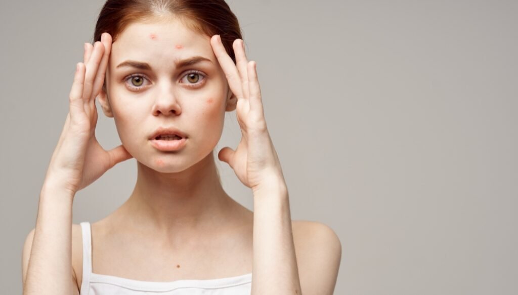 Stress related skin problems in Dubai