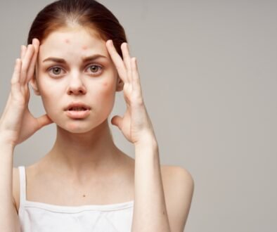 Stress related skin problems in Dubai