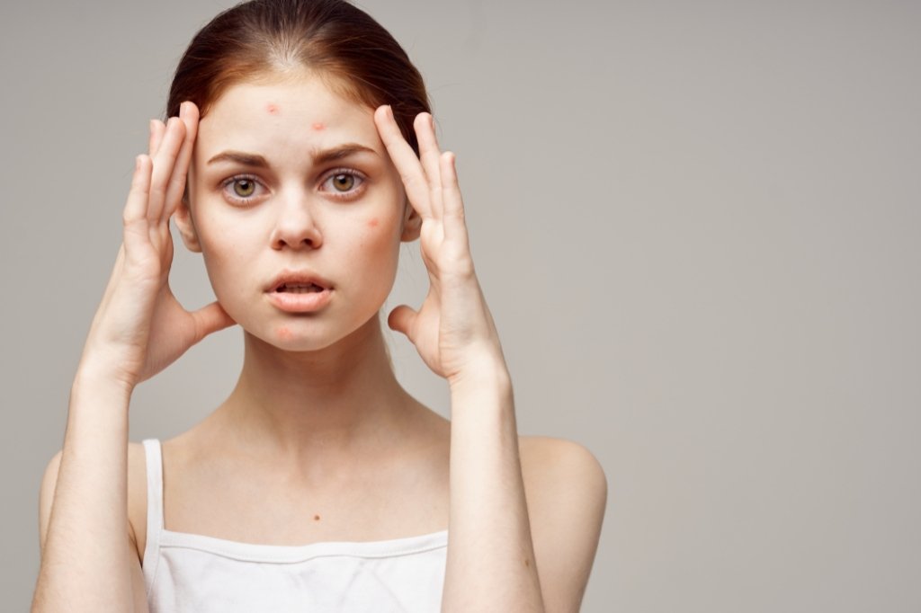 Stress related skin problems in Dubai