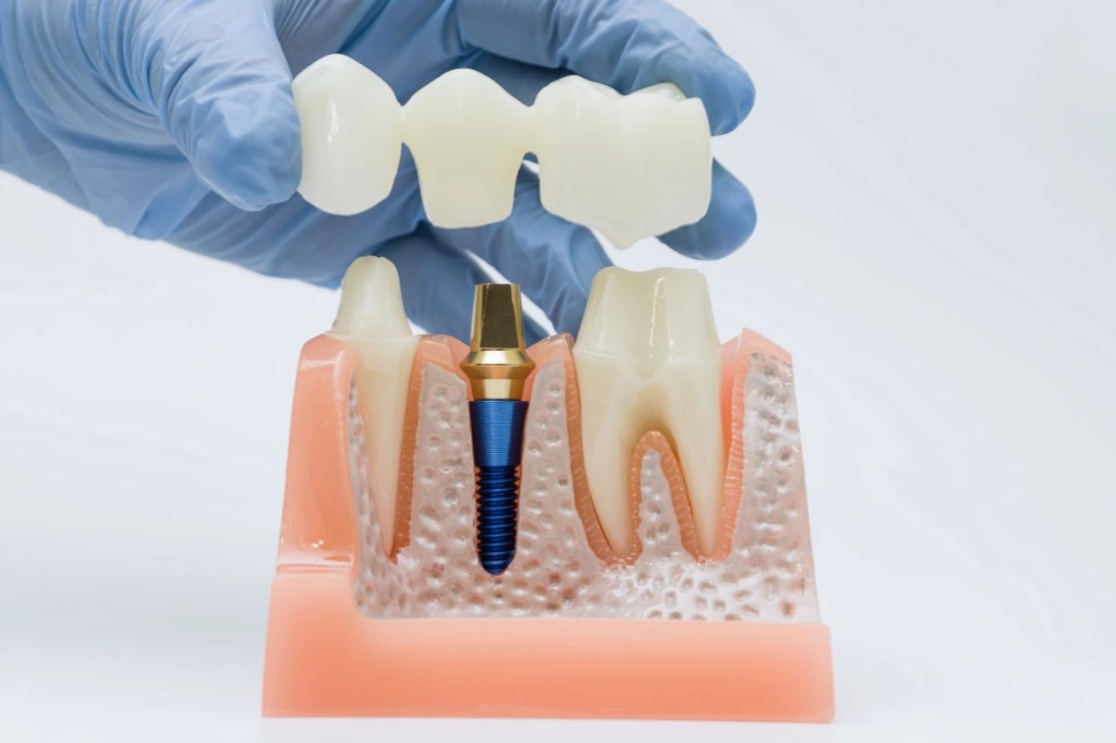 dental crowns in dubai