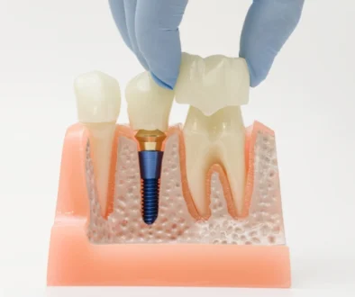 dental crowns in dubai